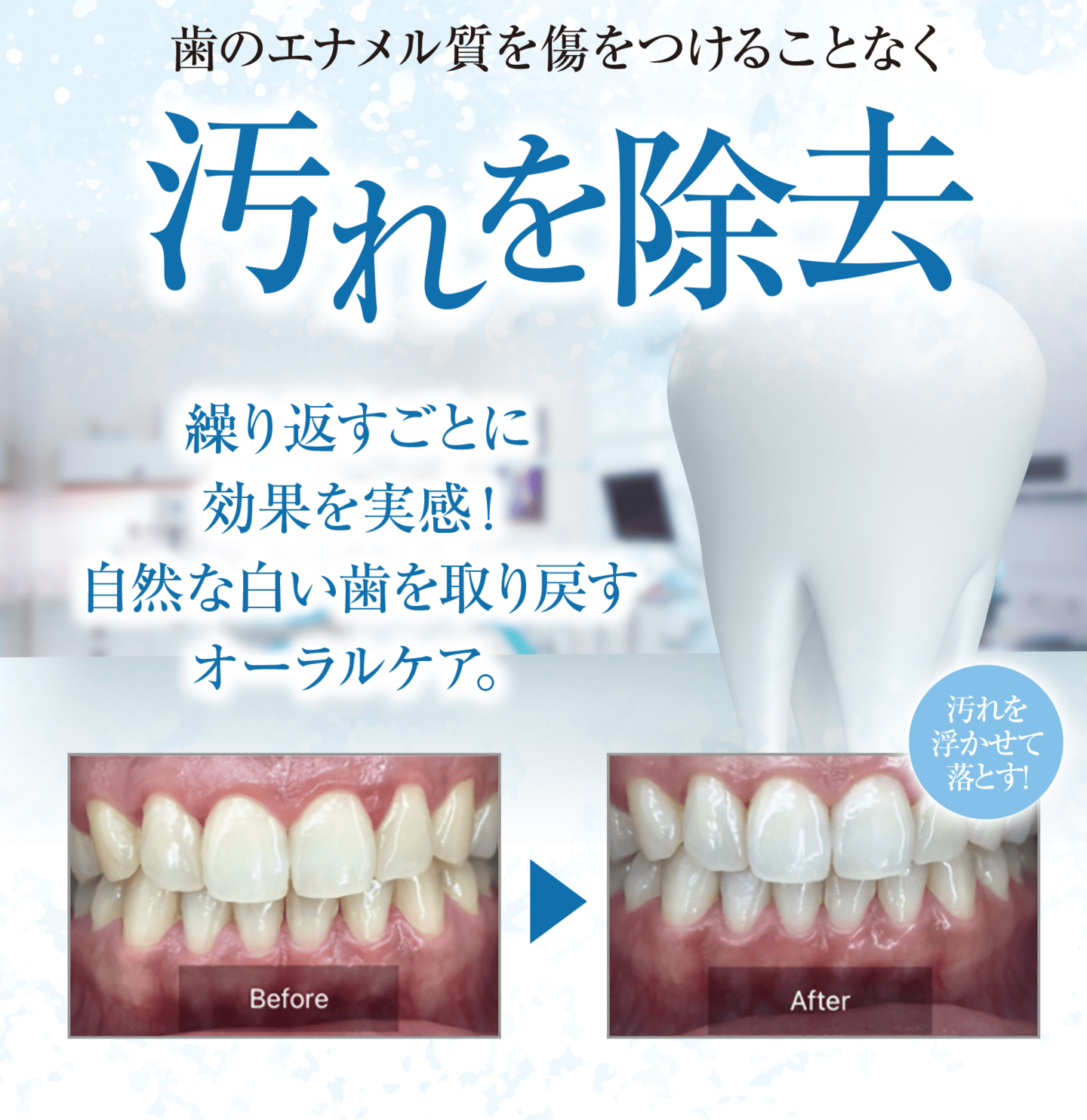 松山ホワイトニング汚れを除去